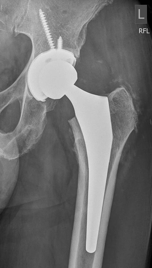 Defective hip implants have been recalled by several manufacturers