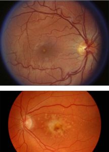 Retinal maculopathy - Elmiron